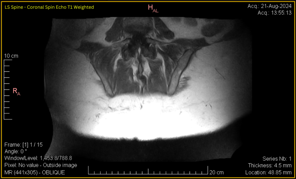 LS Spine - Coronal SE T1 (contrast adjusted) 1 of 15