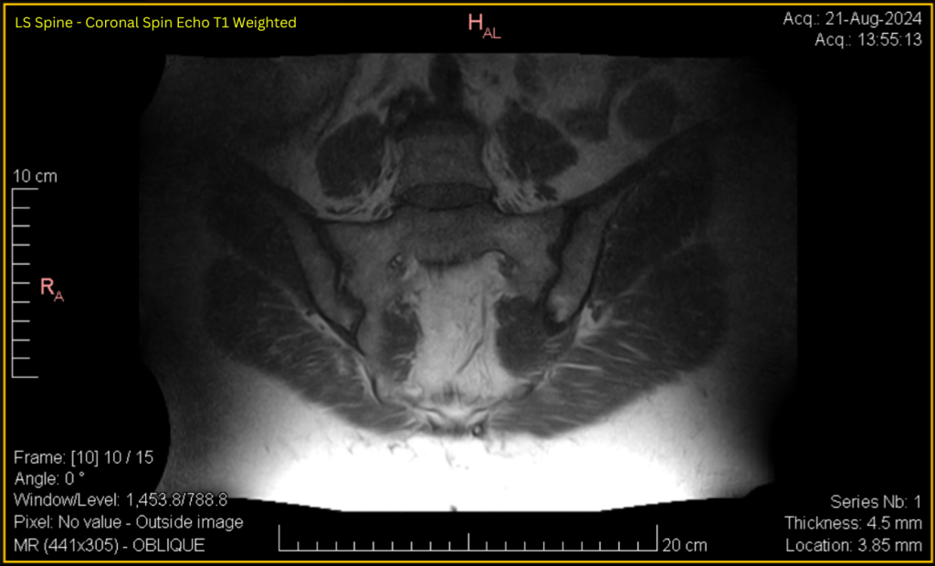 LS Spine - Coronal SE T1 (contrast adjusted) 10 of 15