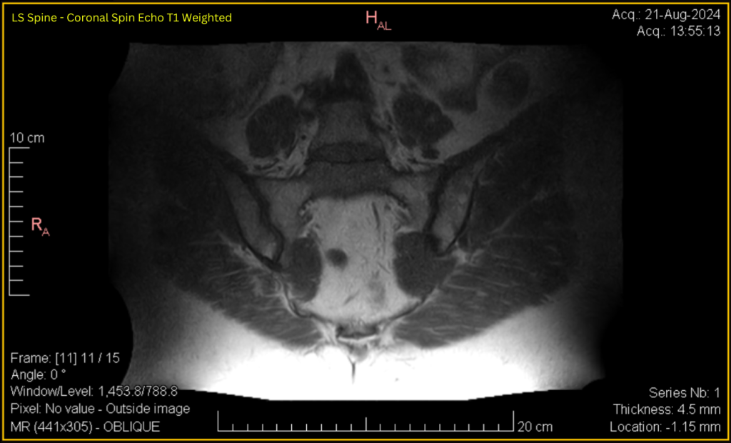 LS Spine - Coronal SE T1 (contrast adjusted) 11 of 15