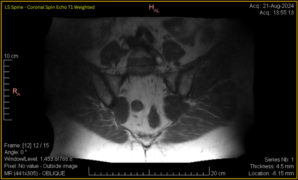 LS Spine - Coronal SE T1 (contrast adjusted) 12 of 15