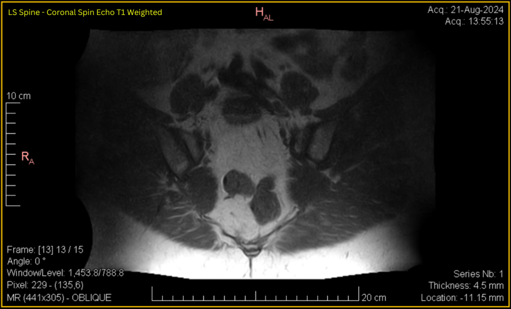 LS Spine - Coronal SE T1 (contrast adjusted) 13 of 15