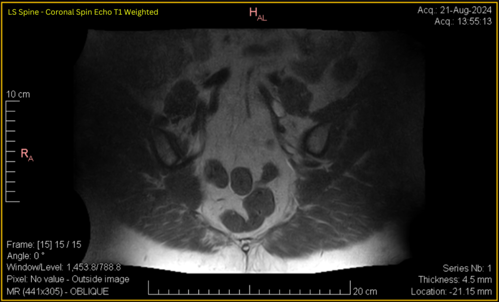 LS Spine - Coronal SE T1 (contrast adjusted) 15 of 15