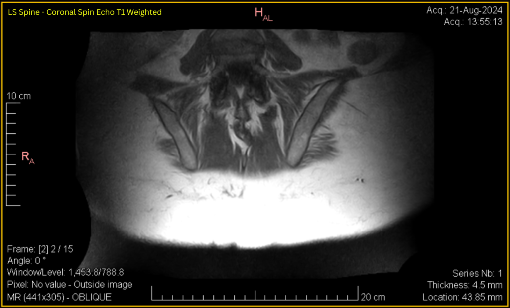 LS Spine - Coronal SE T1 (contrast adjusted) 2 of 15