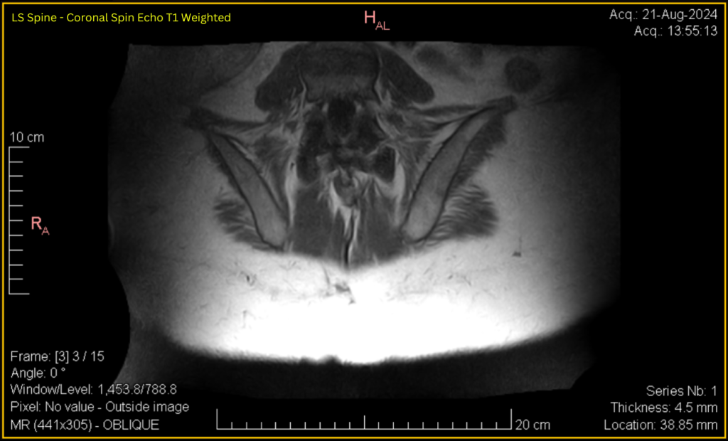 LS Spine - Coronal SE T1 (contrast adjusted) 3 of 15