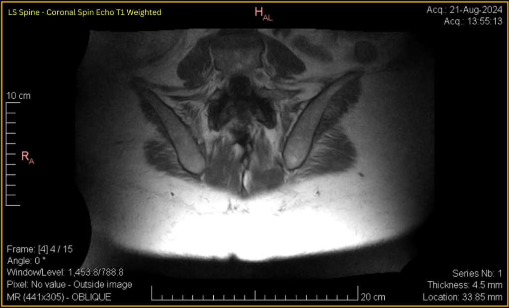 LS Spine - Coronal SE T1 (contrast adjusted) 4 of 15
