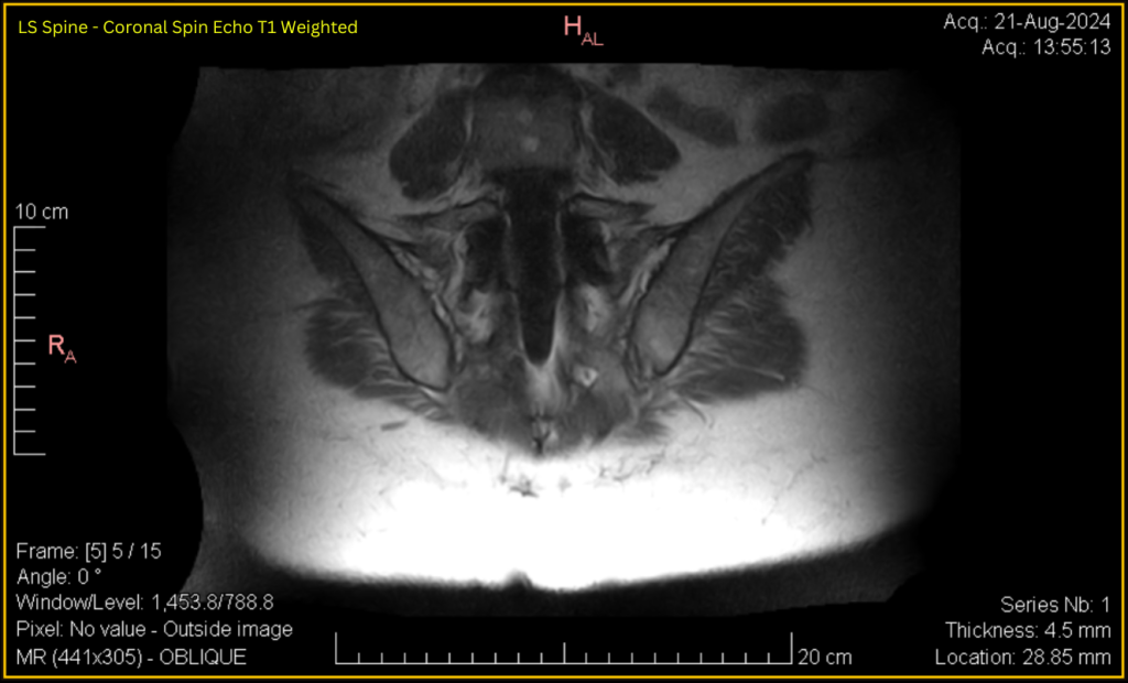 LS Spine - Coronal SE T1 (contrast adjusted) 5 of 15