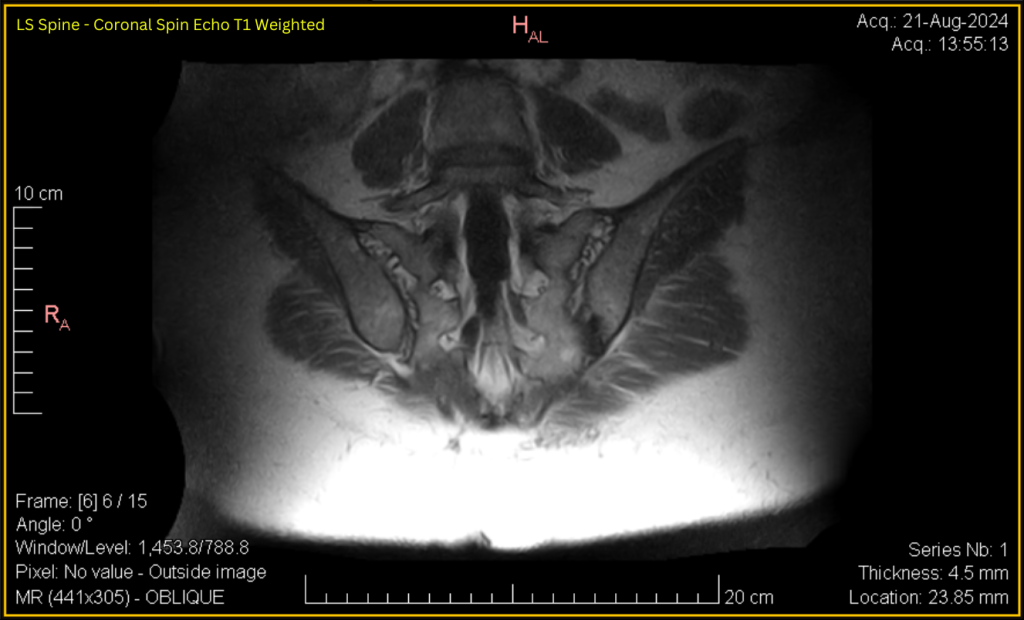 LS Spine - Coronal SE T1 (contrast adjusted) 6 of 15