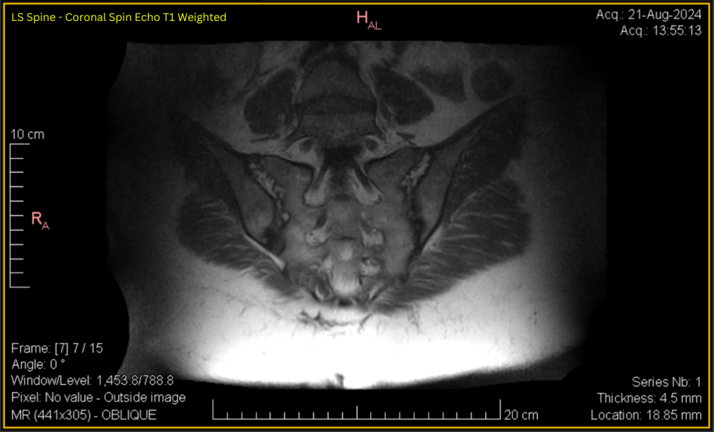 LS Spine - Coronal SE T1 (contrast adjusted) 7 of 15