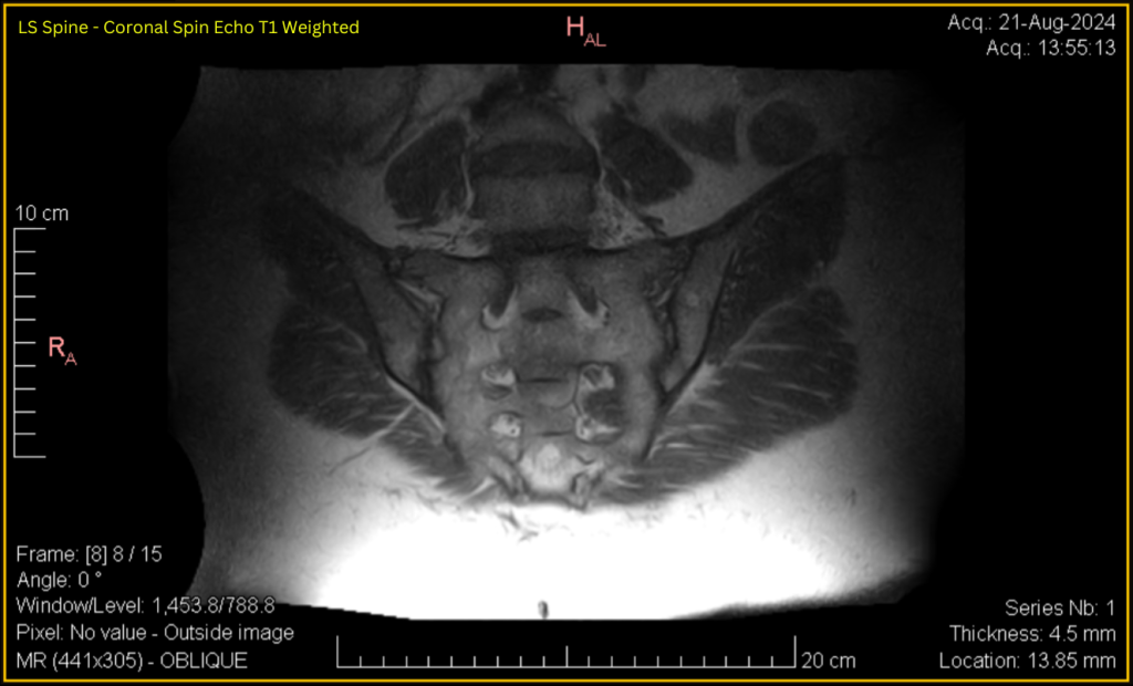 LS Spine - Coronal SE T1 (contrast adjusted) 8 of 15