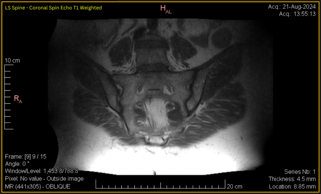 LS Spine - Coronal SE T1 (contrast adjusted) 9 of 15